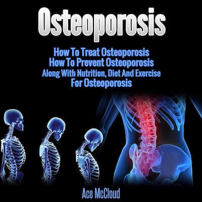 Osteoporosis: How To Treat Osteoporosis: How To Prevent Osteoporosis: Along With Nutrition, Diet And Exercise For Osteoporosis